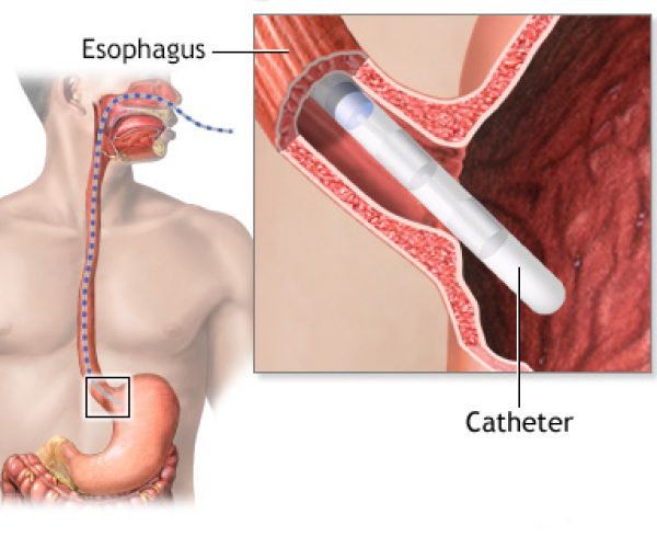 Esophageal manometry test illustration showing catheter-based assessment of swallowing function, GERD, and esophageal motility disorders at Jainamshree Multispeciality Hospital, Bhopal.