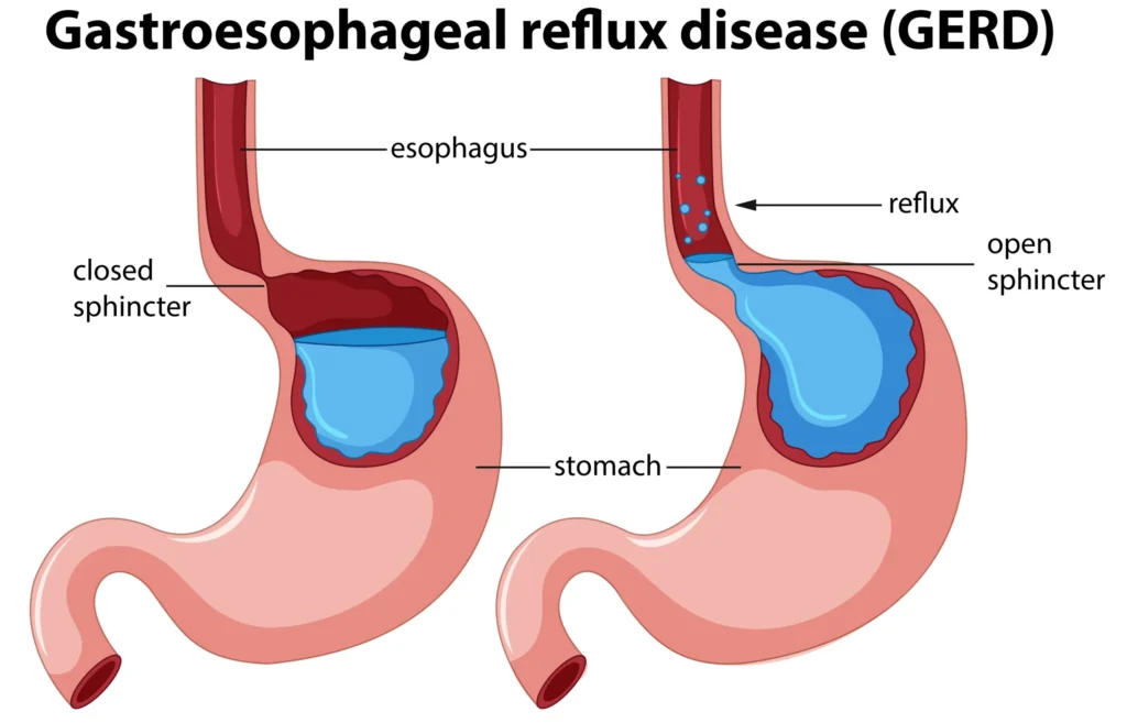 GERD (Gastroesophageal Reflux Disease) illustration showing acid reflux from the stomach into the esophagus due to an open lower esophageal sphincter. Expert GERD diagnosis and treatment at Jainamshree Multispeciality Hospital, Bhopal.