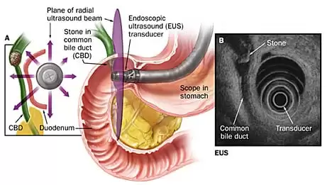 Endoscopic Ultrasound (EUS) illustration showing ultrasound-guided imaging of the bile duct and detection of a common bile duct stone. Advanced EUS diagnosis and treatment at Jainamshree Multispeciality Hospital, Bhopal.