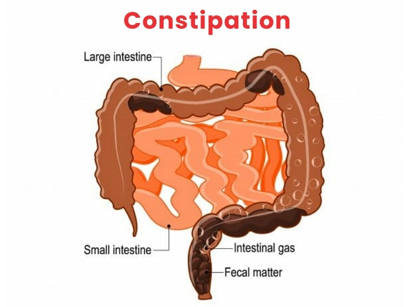 Constipation-Treatment-in-Bhopal-.jpg
